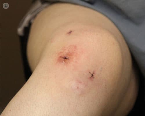 Encuentra a tu traumatólogo para lesiones de rodilla en Almería