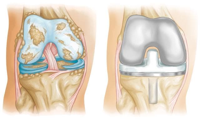 Encuentra a tu traumatólogo para lesiones de rodilla en Almería